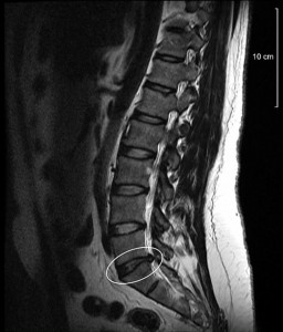MRI of lower back